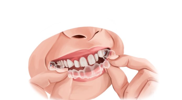 Tips For Taking Care Of Your Metal Braces From An Orthodontist In Miami