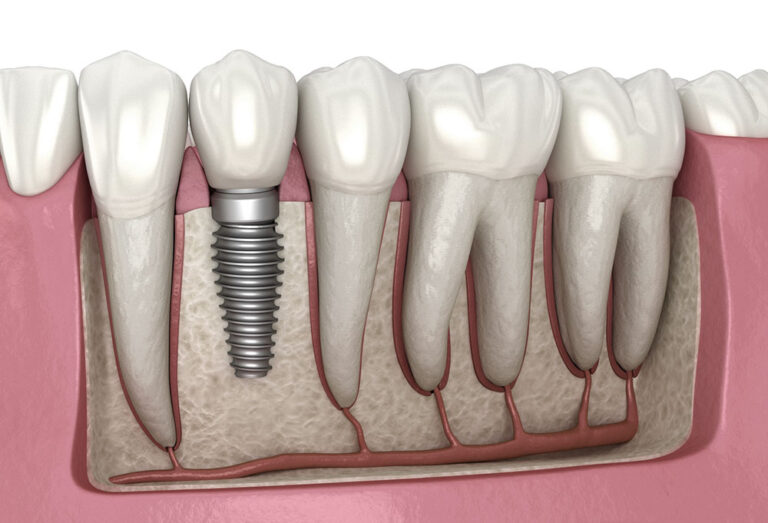 Are You Eligible for Dental Implants in Broomfield? Consult with Your Dentist to Know