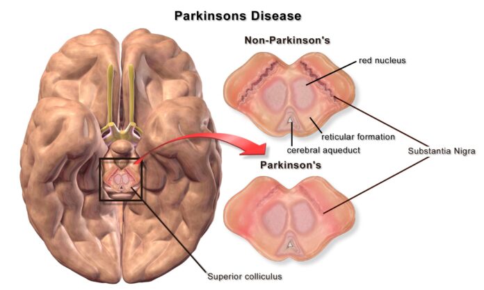 Neurodegenerative Diseases