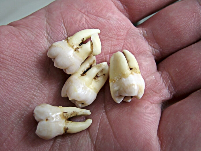 Wisdom Teeth